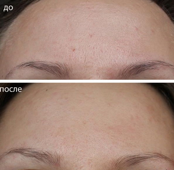 Лицо после косметолога: до и после